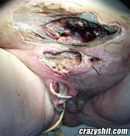 Bad case of gut rot
