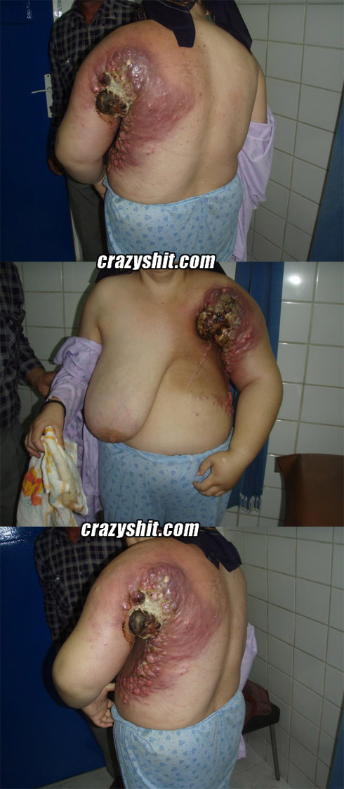 Breast cancer aftermath