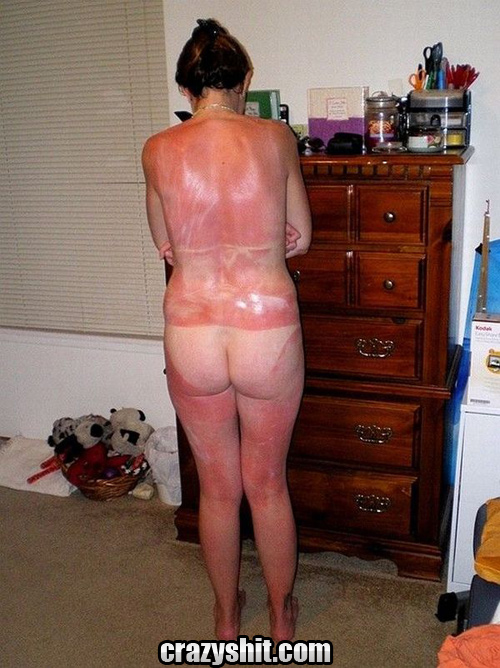 Nude Sunburned Babe