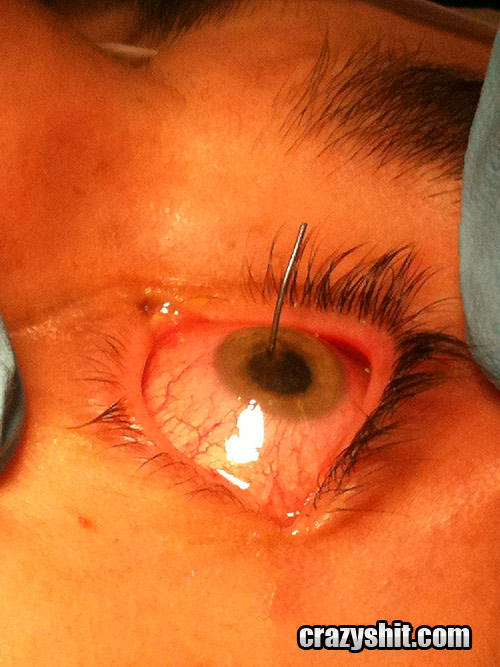 User Eye Injury