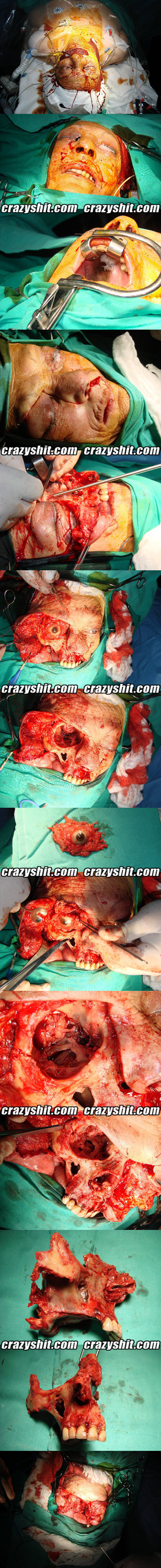 Deconstructive Face Surgery