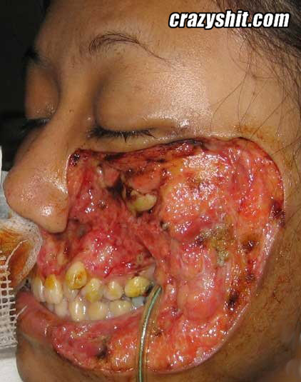 Bacteria Ate Her Face Off
