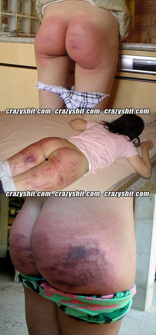 Spanked Bruised Butt - CrazyShit.com | Spank That Ass Til It's Black and Blue ...