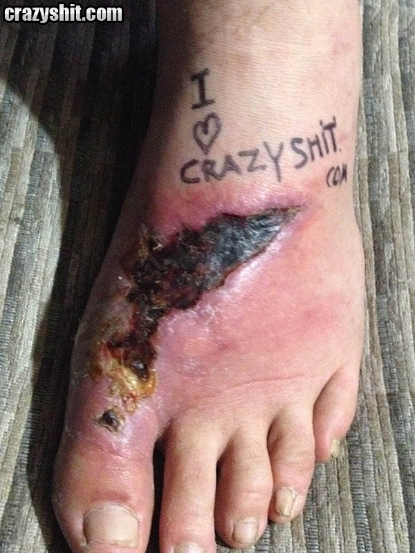 User Submitted Foot Wound