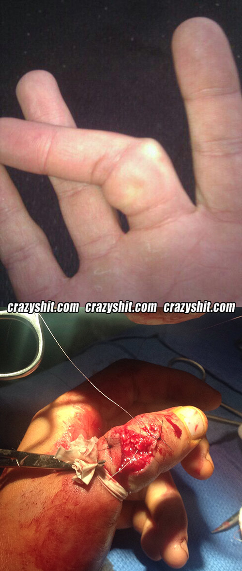 Crazyshit User Busted Fingers