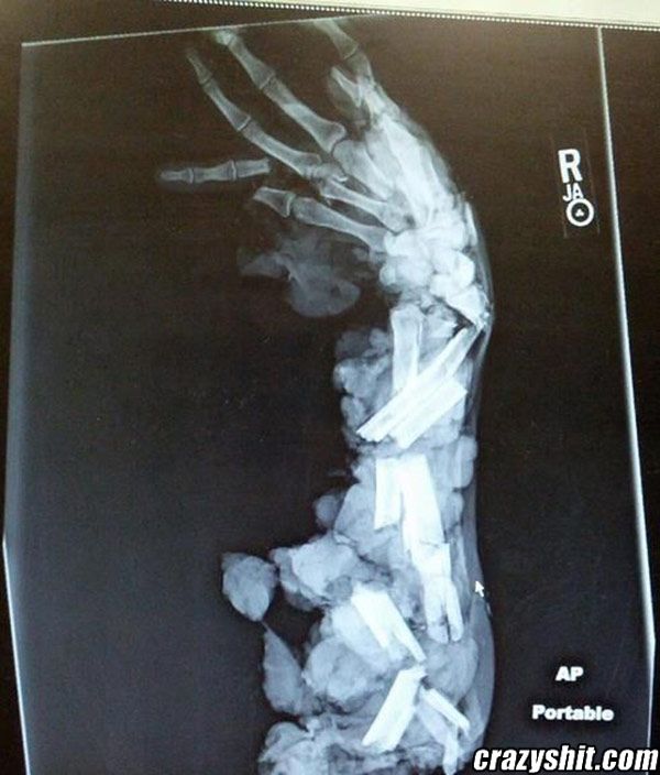 Arm Looks To Be Broken