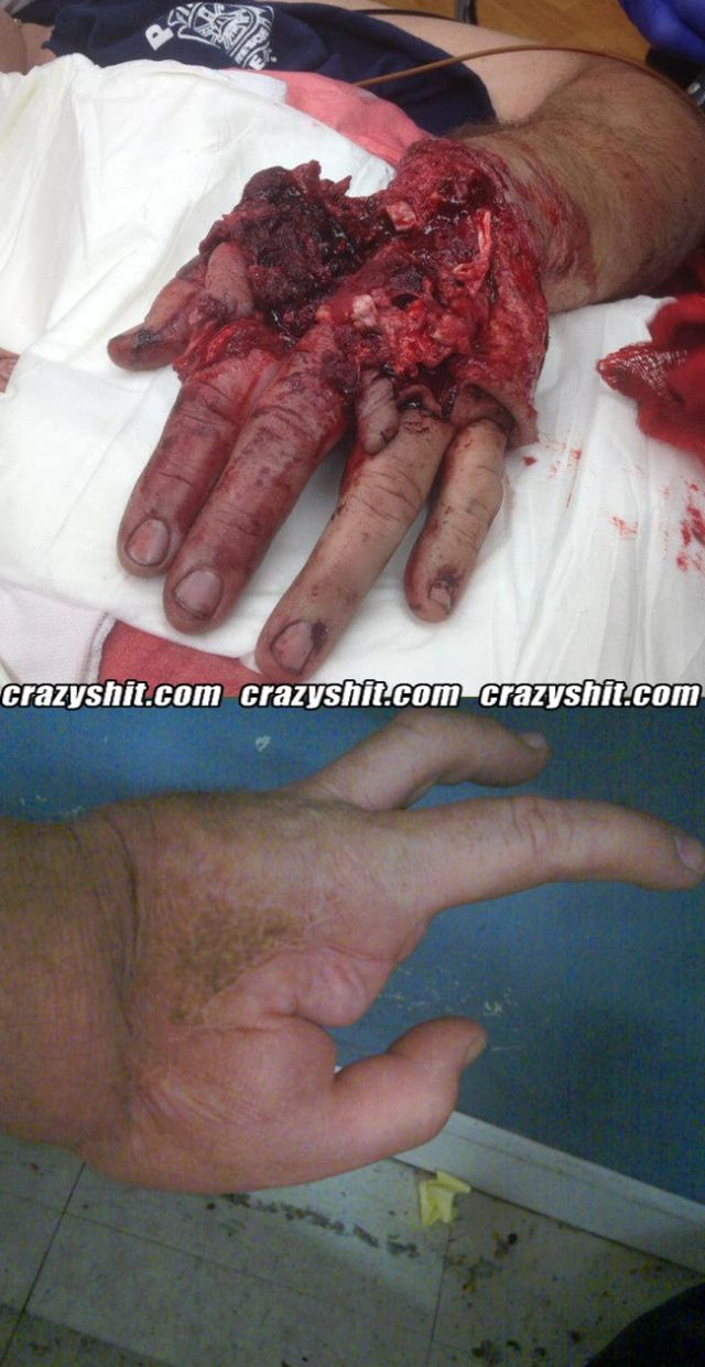 Before After of Shooting Your Hand