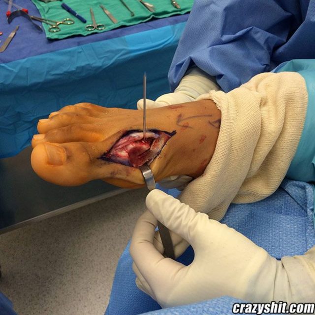 Surgery Foot Pussy
