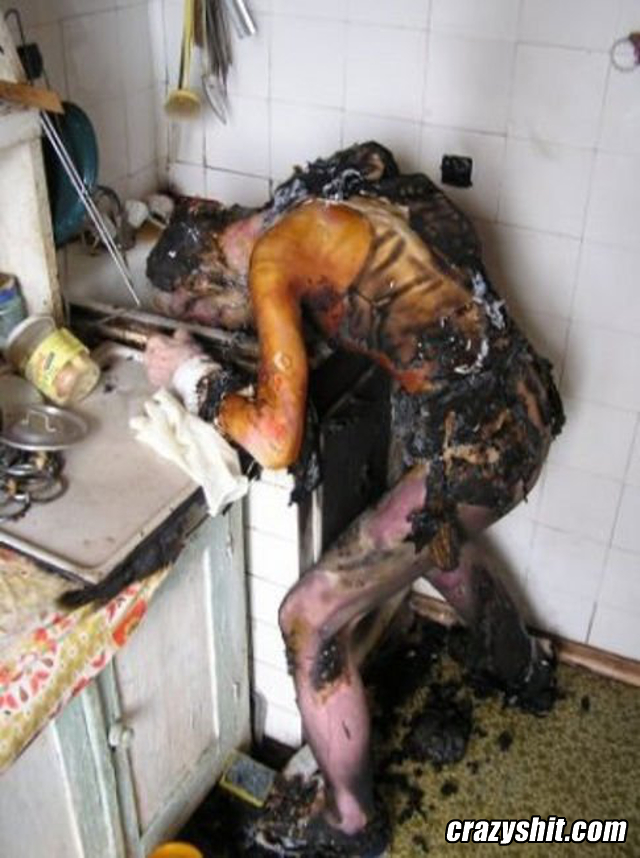 Burned Himself Cooking