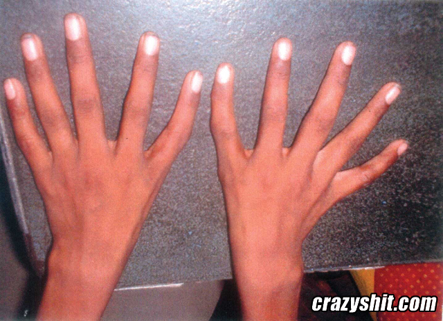Five Fingers No Thumbs