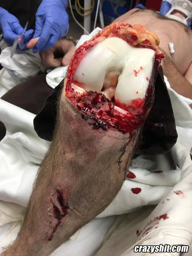 Exposed Broken Knee