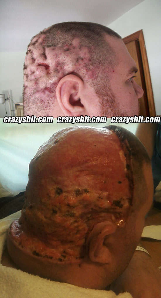 Cellulitis of the scalp