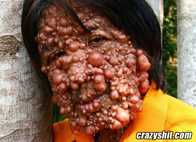 Face Full Of Warts