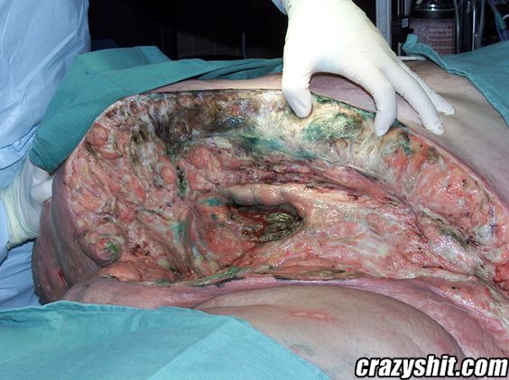 C-Section Infection