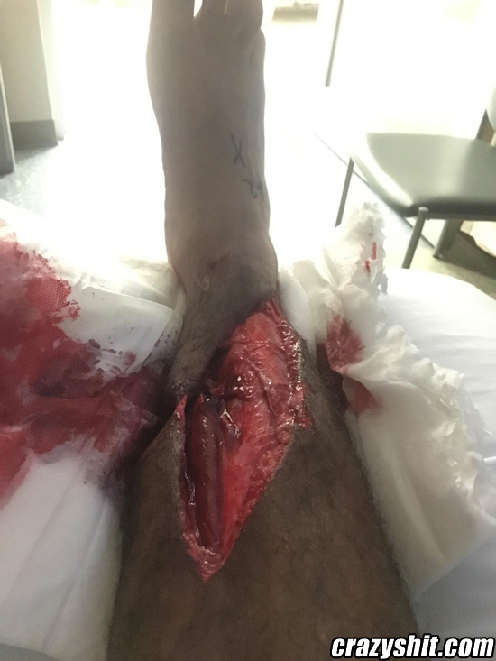 Some XL wound pussy for you
