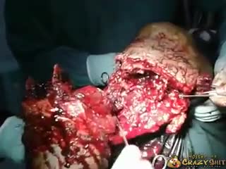 CrazyShit.com | Leg Amputation - Crazy Shit