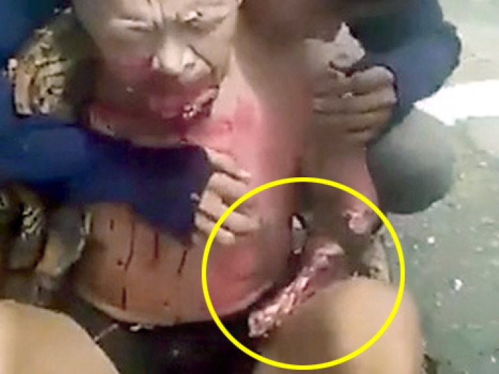 CrazyShit.com | BRUTAL: ACCIDENT LITERALLY RIPS HAND DOWN TO THE BONE - Crazy Shit