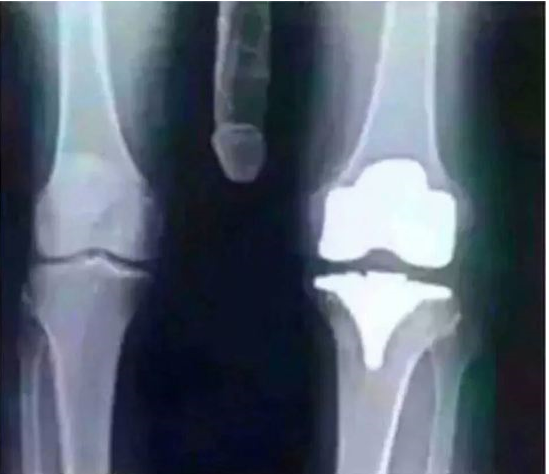 My knee replacement