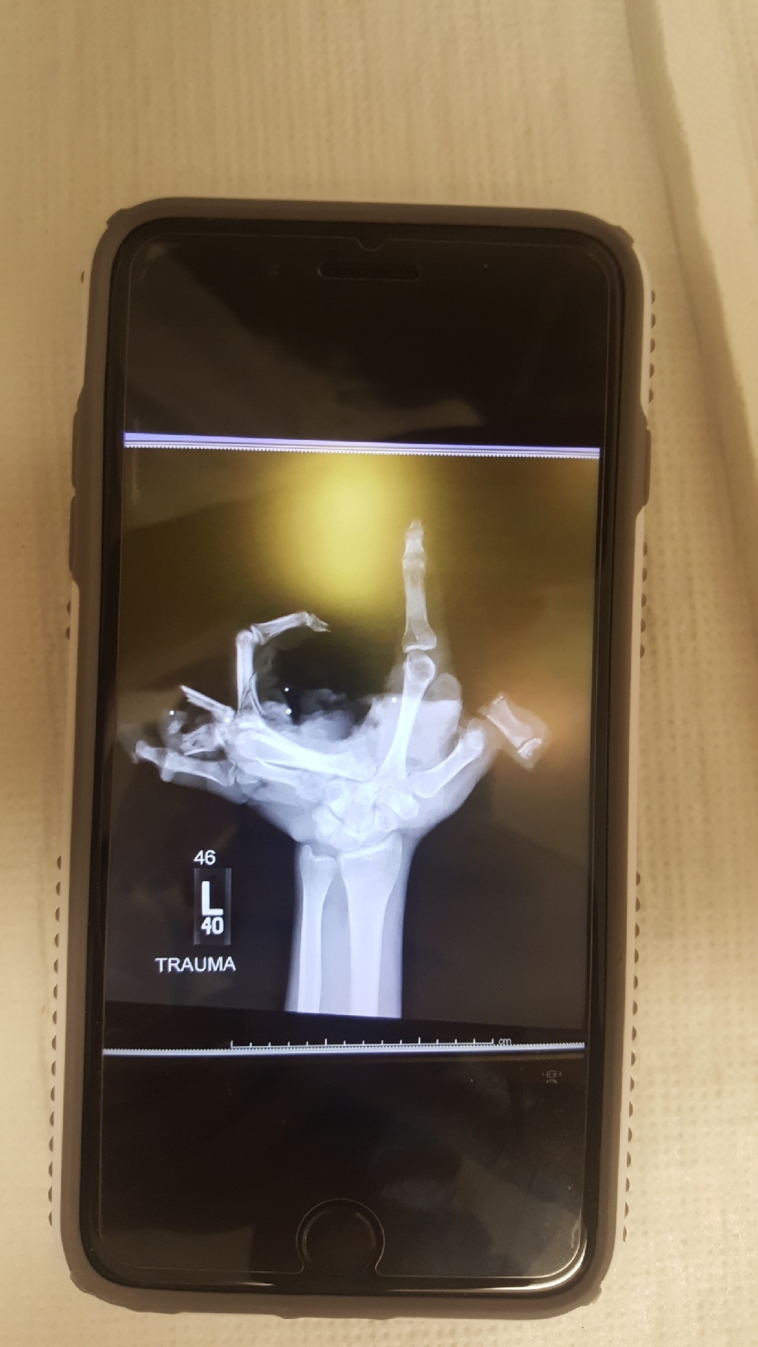 Blown off hand #3