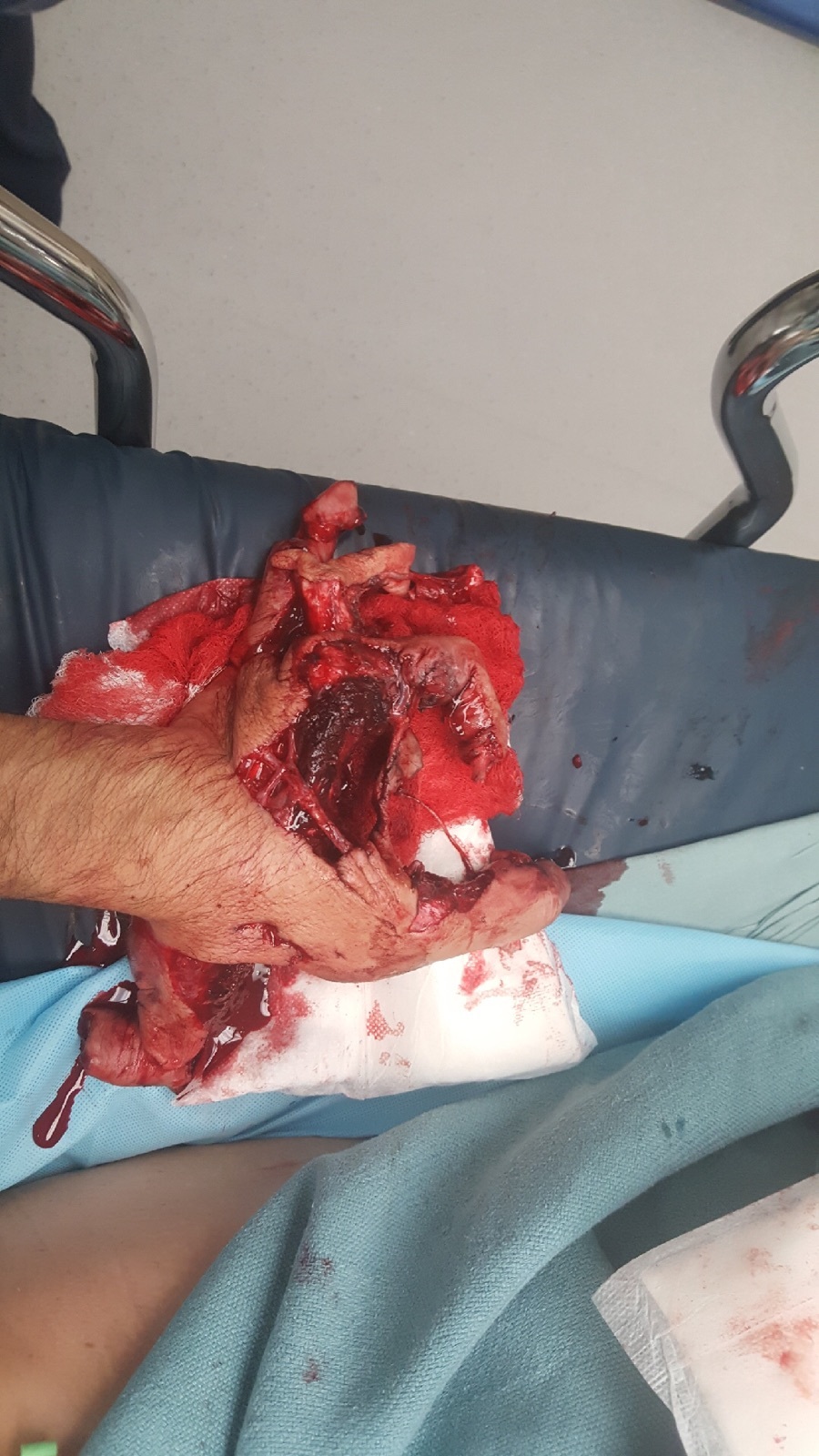 Blown off hand #2