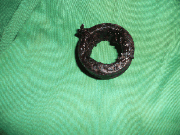 Strangulated Gangrene penis from metal cock ring.