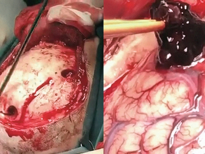 CrazyShitcom BRAIN HEMORRHAGE SURGERY IS PRE