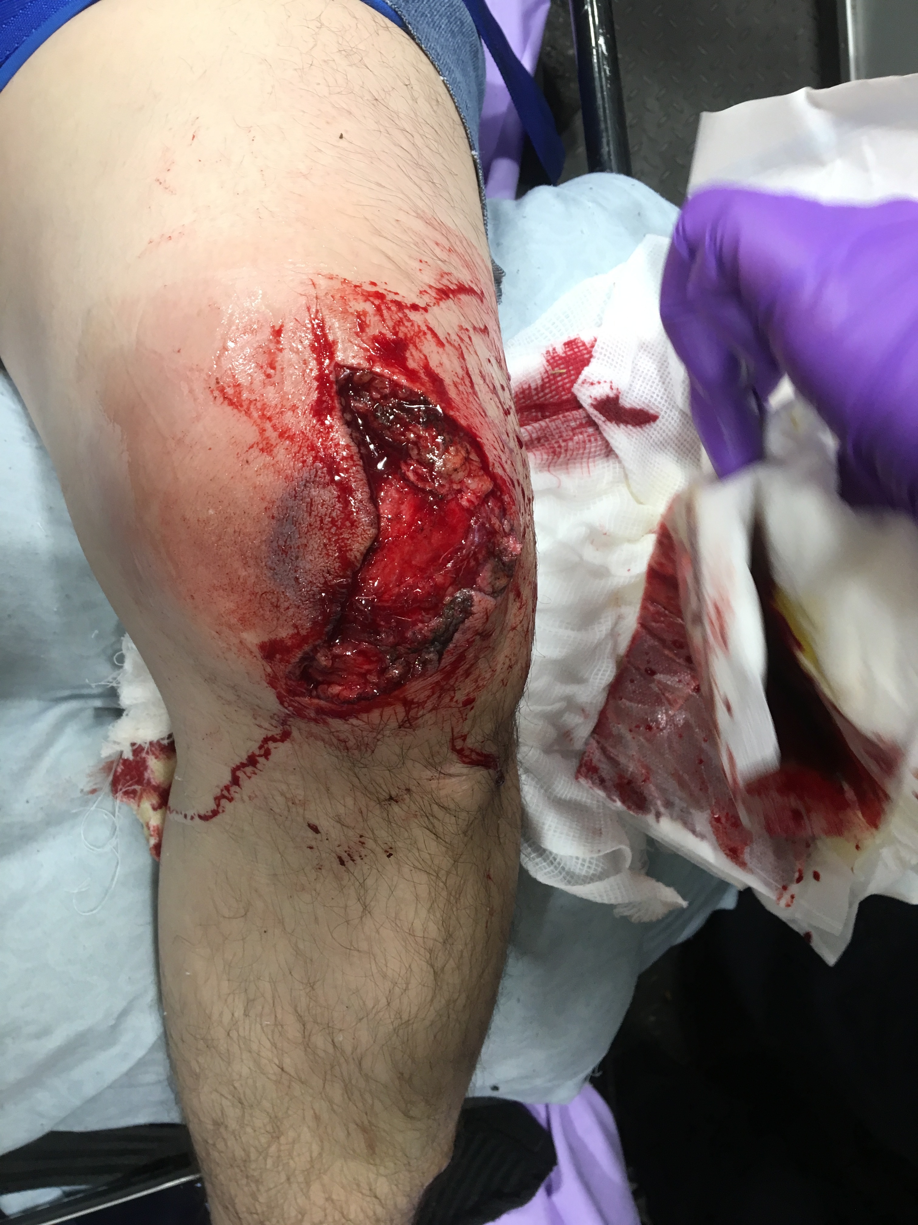 My broken leg