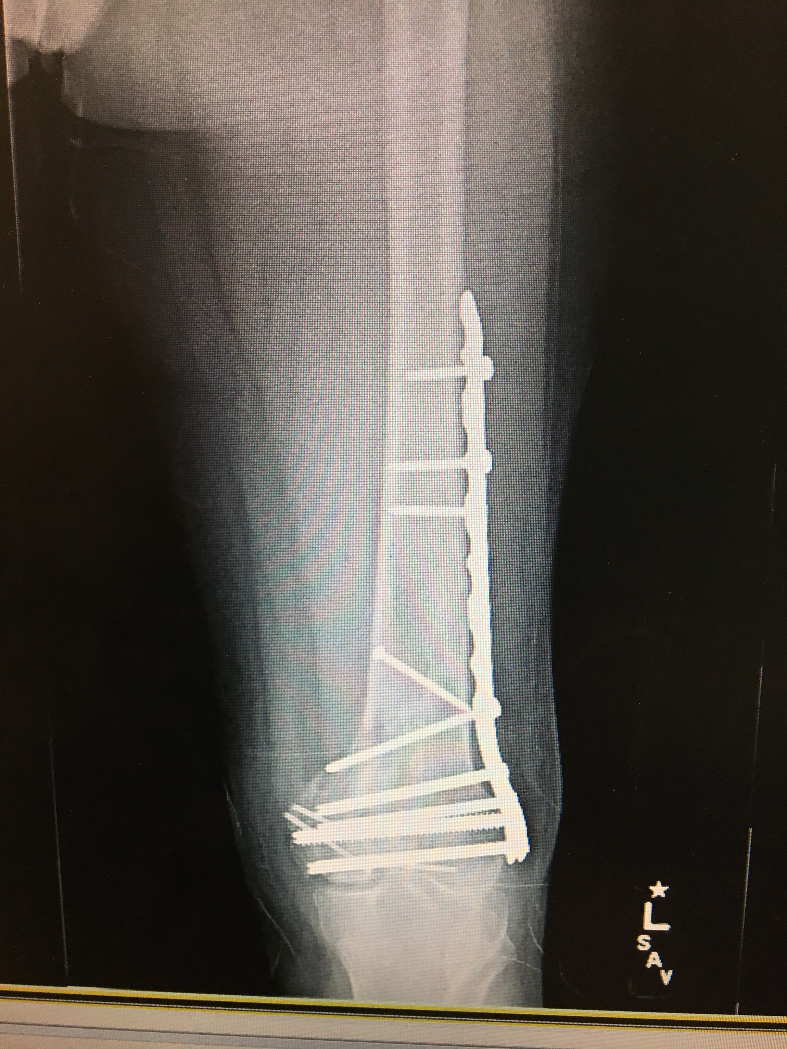 X-Ray of knee from firework disaster