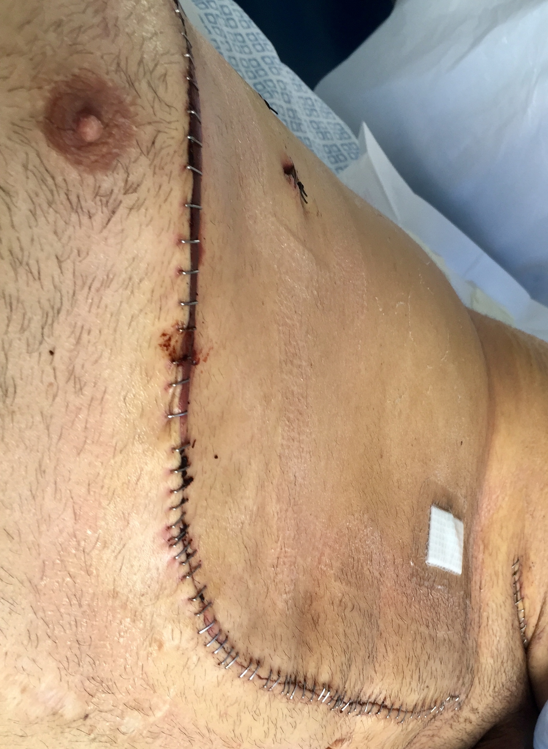 My surgery