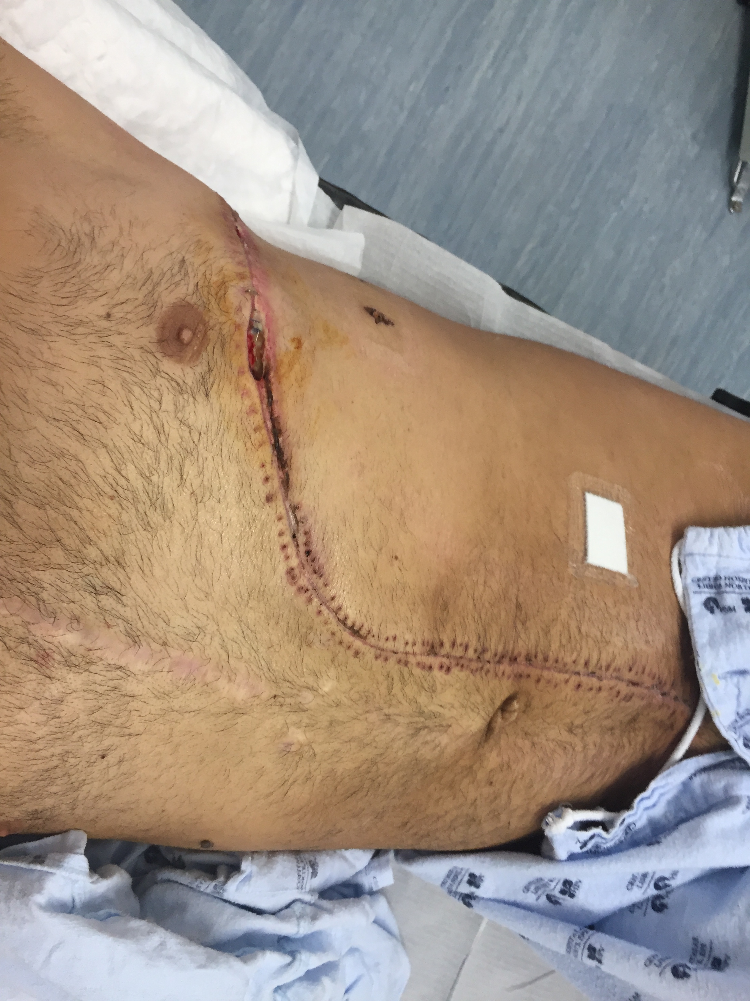 My surgery