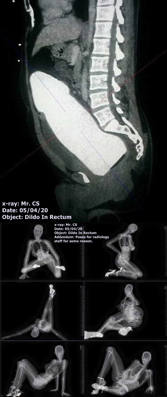 A BURFURGER NEWZ EXCLUSIVE!! Mr. CS LIES ABOUT NOT GETTING X-RAYS!