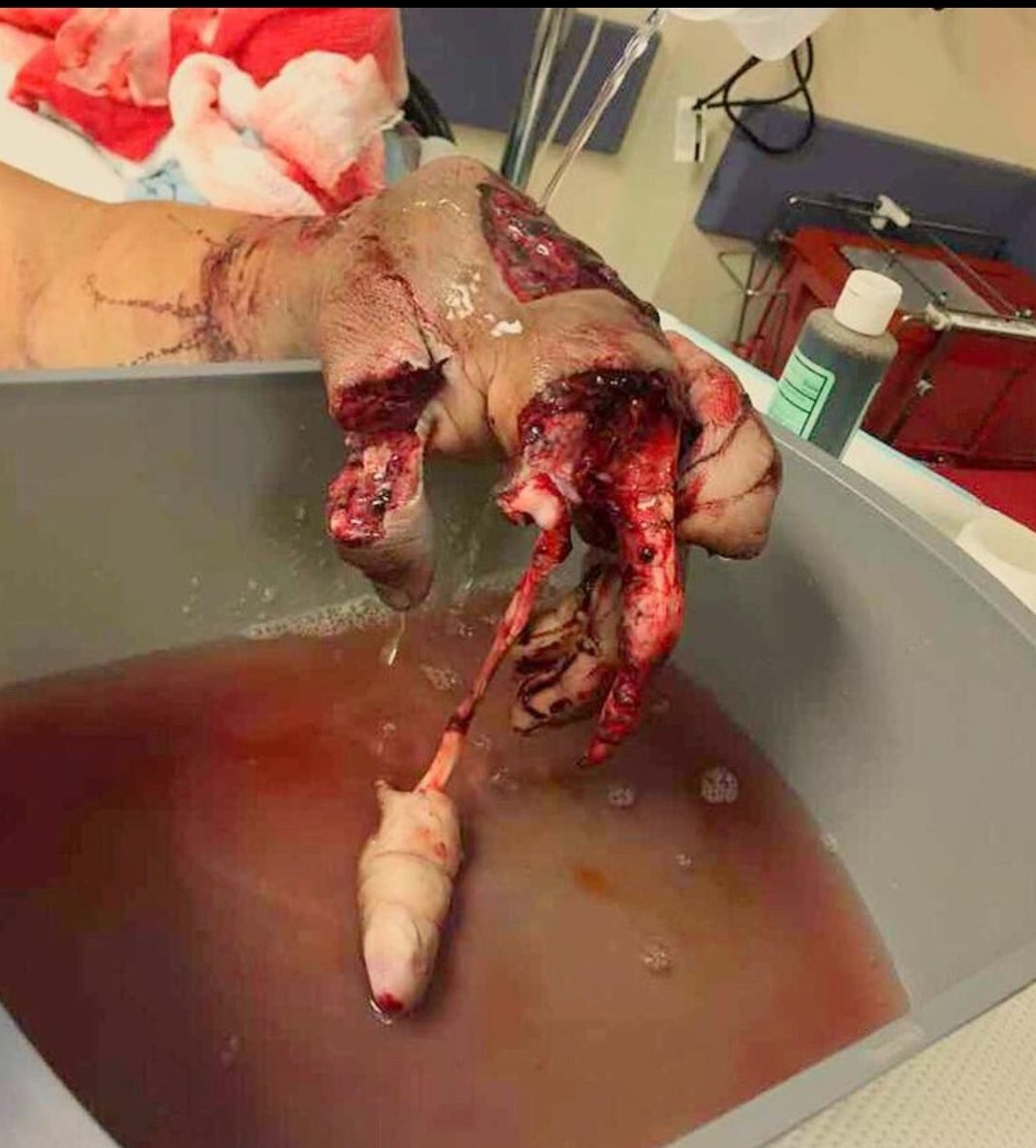 Mangled hand