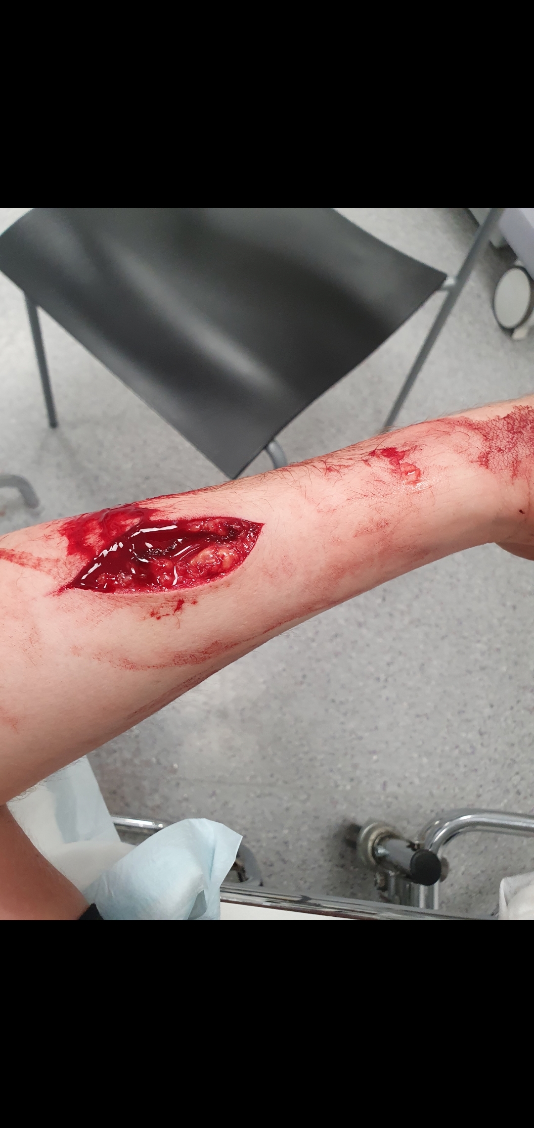 Cut with a razorblade