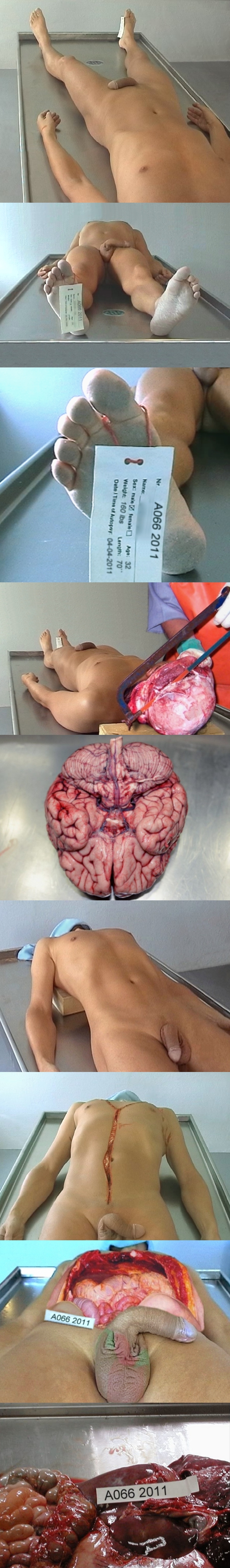 Autopsy of a 32 year old guy