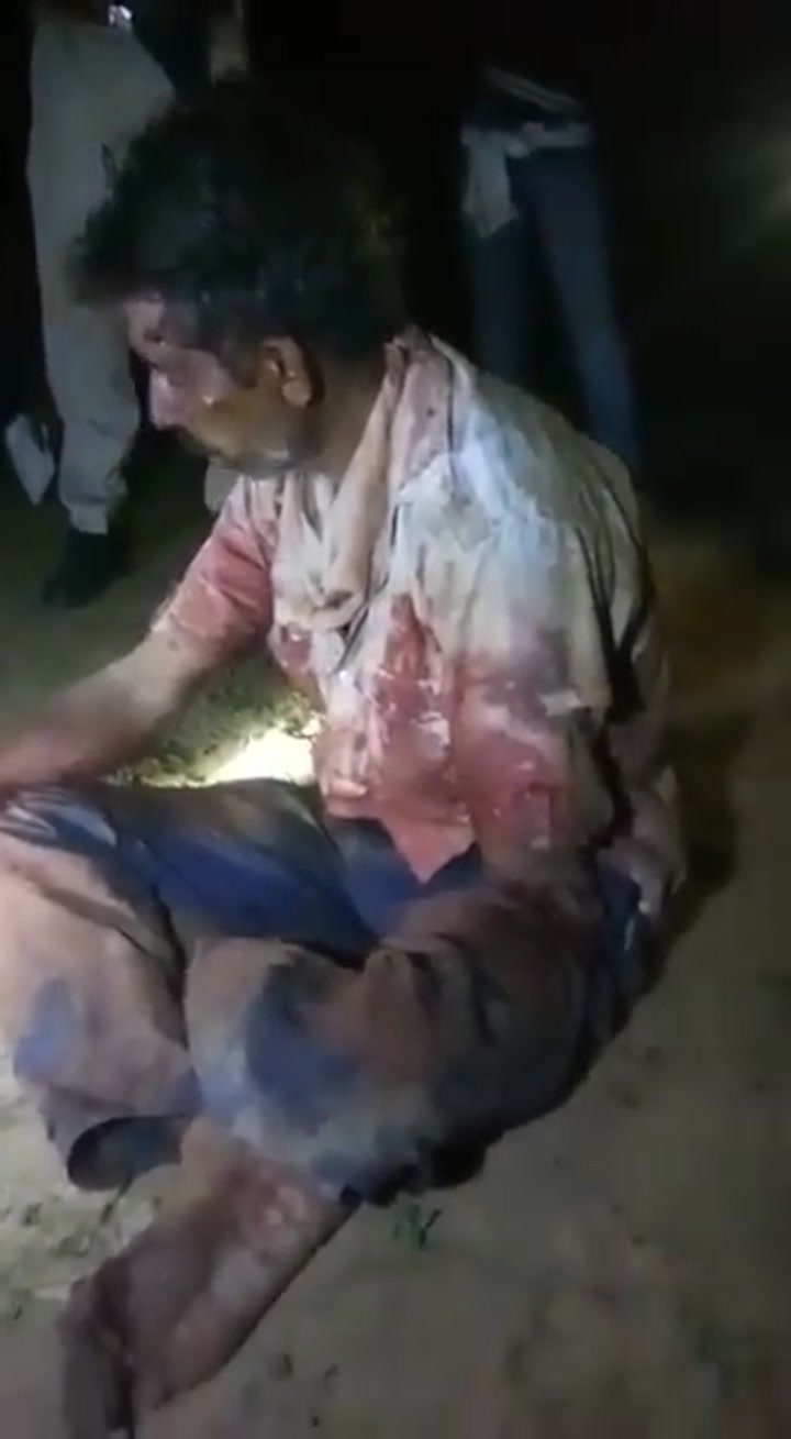 CrazyShit.com | Train accident survivor lost both hands - Crazy Shit