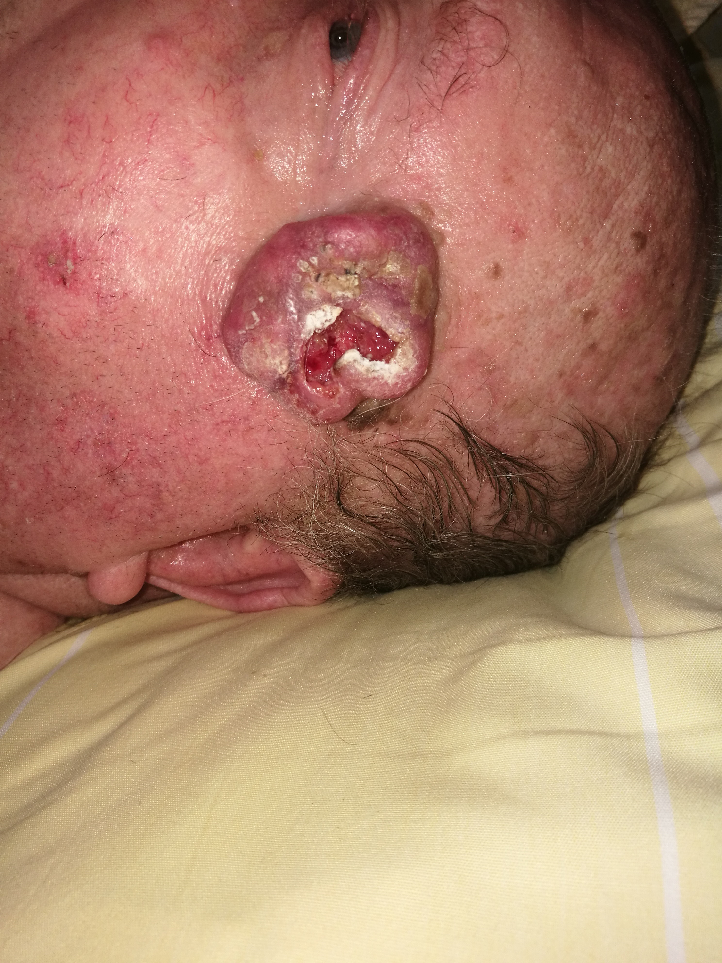 Skin tumor