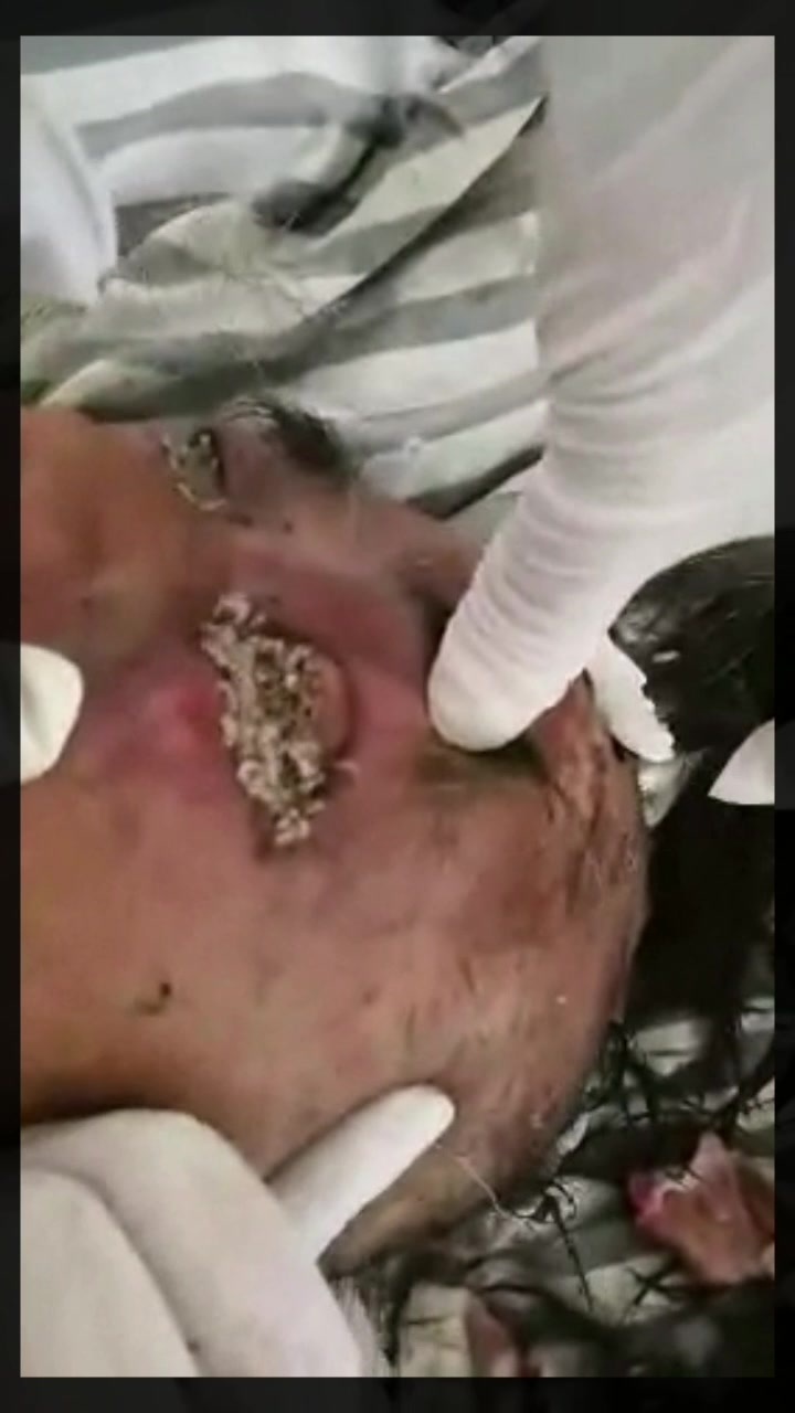 CrazyShit.com | Eaten alive by maggots 