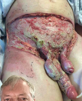 Extensive necrotizing fasciitis of the Ying-Yang,.
