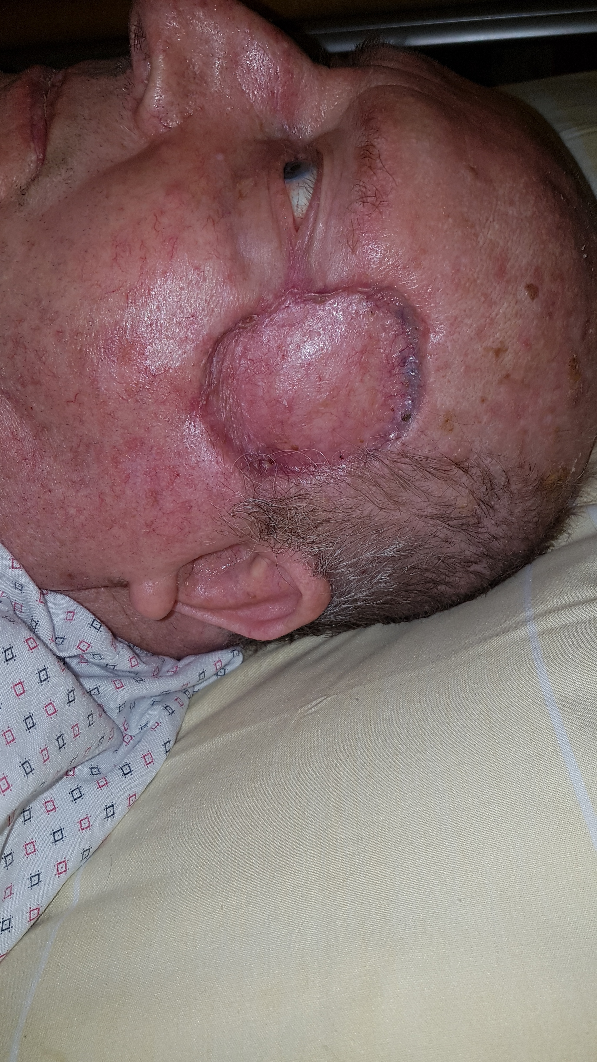 Follow up to Skin Tumor after tumor excision and skin transplantation (link in description)