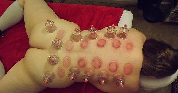 Cupping&hellip;..