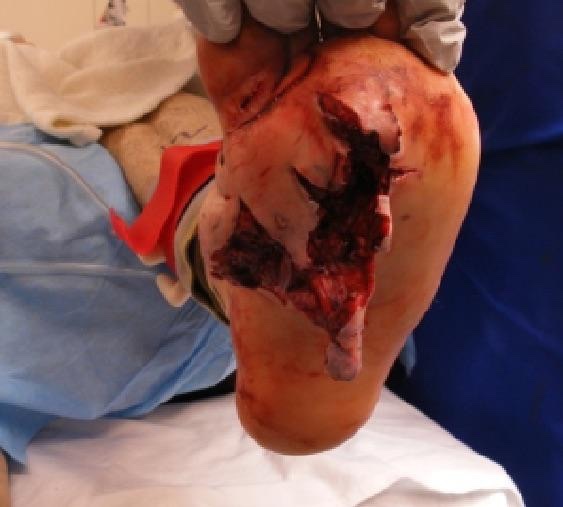 Shot Through The Foot&hellip;..