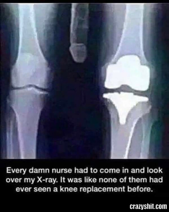 X-ray 3rd leg