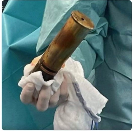 88-year-old man hospitalized with grenade in rectum