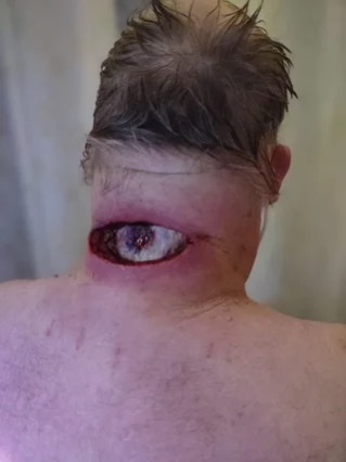Infected neck cyst