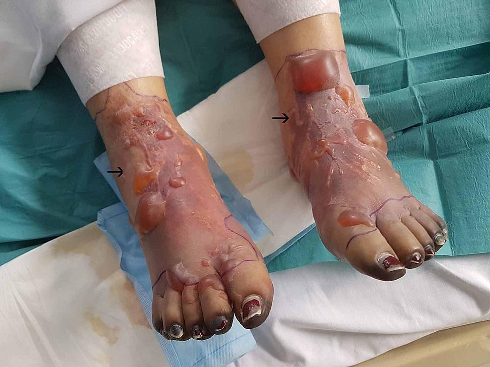 The Blister&hellip;..