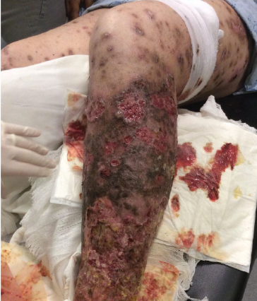 leg ulcers from krokodil injections