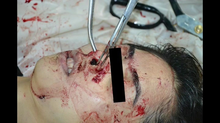 CrazyShit.com | 23 year old woman accidental falling death. Body exam - Crazy Shit