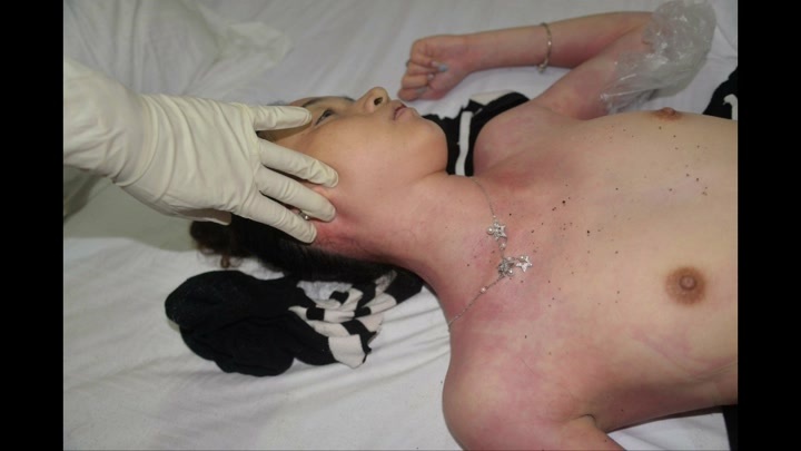 18 Year Old Woman Drug Overdose Death. Body Exam   