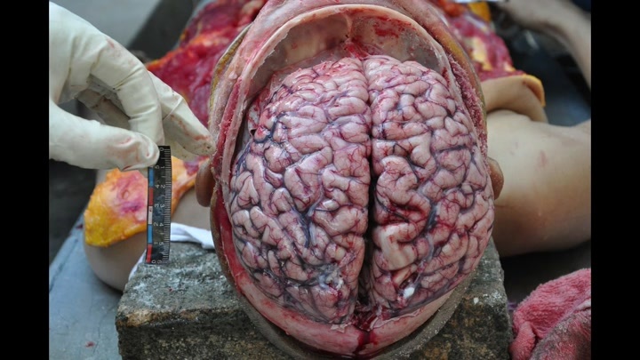 CrazyShit.com | 20 year old woman stabbing murder and brain autopsy - Crazy Shit 