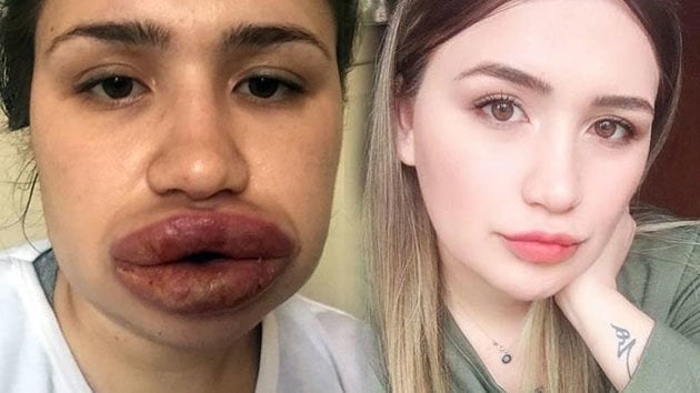 Lip Injected…..